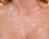 Poitrine et cou d'une personne présentant une dépigmentation de la peau, avec des taches claires et foncées.
