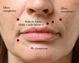 Gros plan sur le bas du visage d'une femme, montrant les sillons nasogéniens, les rides du fumeur et les plis d'amertume.