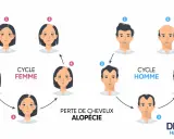 Illustration du cycle de perte de cheveux chez l'homme et la femme, montrant l'impact de la dht hormone sur l'alopécie.