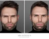 Brak efektu po botoksie? Ekspert wyjaśnia i radzi, co dalej