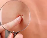 Un doigt pointe un grain de beauté qui saigne, observé à travers une loupe sur une peau claire.