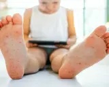 Małe czerwone kropki na stopach dziecka, które mogą wskazywać na wysypkę. Dziecko siedzi, trzymając tablet.