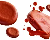 Rozpad czerwonych krwinek, czyli hemoliza. Co to jest? Obraz pokazuje uszkodzone erytrocyty i wypływającą z nich hemoglobinę.