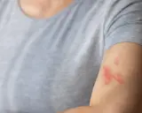 Osoba z wysypką na ramieniu, która może wymagać leków na półpasiec.