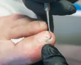 Prise en charge podologue diabète : un professionnel utilise un instrument pour nettoyer délicatement un ongle de pied, assurant des soins essentiels.