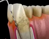 Model szczęki z widocznym zapaleniem kieszonki dziąsłowej. Narzędzie dentystyczne usuwa kamień nazębny spod linii dziąseł.