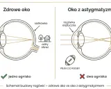 Zdrowe oko ma kulistą rogówkę i jedno ognisko, dając ostry obraz. Oko z astygmatyzmem ma eliptyczną rogówkę, co powoduje dwa ogniska i rozmyty obraz.