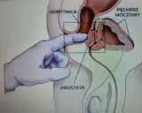 Ilustracja medyczna pokazująca palec w rękawiczce wykonujący masaż prostaty przez odbytnicę.