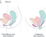 Ilustracja porównuje prawidłowy i osłabiony stan dna miednicy. Wypadająca macica objawy mogą być widoczne przy osłabieniu mięśni.