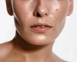 Błyszcząca skóra z widocznym nadmiarem sebum na twarzy. Domowe sposoby na przetłuszczanie skóry mogą pomóc przywrócić jej równowagę.