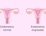 Comparación visual de un útero con endometrio normal y otro con endometrio engrosado, indicativo de hiperplasia endometrial.