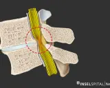 Darstellung einer Spinalkanalstenose, die Nervenwurzeln komprimiert. Eine Operation kann hier Linderung verschaffen.