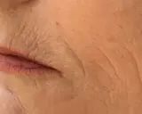 Nahaufnahme der Lippen und der Haut einer älteren Person mit tiefen Falten, die auf die Auswirkungen des Rauchens hinweisen. Kleine Pickel sind sichtbar.