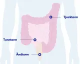 Illustration av tunntarm, tjocktarm och ändtarm. Kan ge en känsla av svullen mage och illamående.