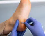 Un podologue enlève une callosité au pied avec un scalpel.