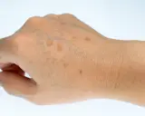 Gros plan sur le dos d'une main montrant plusieurs taches brunes sur la peau, signes du temps ou du soleil.