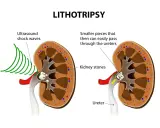 Litotrypsja w urologii: fale ultradźwiękowe rozbijają kamienie nerkowe na mniejsze fragmenty, które łatwiej przechodzą przez moczowód.