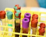 Probówki z krwią w żółtym stojaku laboratoryjnym.