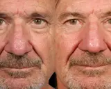 Gros plan sur le visage d'un homme, montrant les effets de la rosacée phymateuse sur son nez et ses joues.