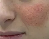 Primo piano del viso con evidente pelle seborroica, arrossamento e pori dilatati sulla guancia.