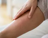 Eine Hand streicht über ein Bein mit geröteter, schuppiger Haut. Das Jucken der beine beim laufen ist deutlich zu spüren.