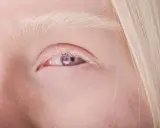 Blond włosy i jasne brwi otaczają fioletowe oczy, świadczące o albinizmie.