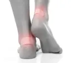 Pieds avec pansements sur les talons pour soulager une phlyctène douloureuse.