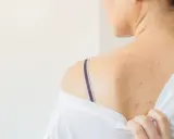 Schiena con eruzioni cutanee rosse, possibili segni di dermatite da sudore. Si cercano rimedi per alleviare il prurito e l'irritazione.