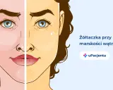 Żółtaczka przy marskości wątroby, jeden z objawów alkoholowego zapalenia wątroby, powoduje zażółcenie skóry.