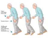 Uomo con tremori alle mani e andatura incerta, sintomi del parkinson. La difficoltà a parlare è un altro sintomo comune.