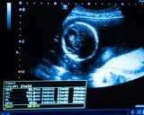 Obraz usg ciąży pokazuje rozwijający się płód. Na ekranie widoczne są pomiary i wiek ciąży.