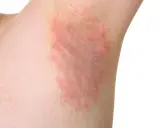 Irritazione cutanea sotto le ascelle, con chiazze rosse e sensazione di prurito sotto le ascelle senza rossore visibile.