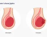Ilustracja porównuje zdrowe jądro z chorym, na którym widoczny jest guz, wskazujący na raka moszny.