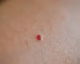 Una piccola macchia rossa sulla pelle, un neo rubino, senza alcun prurito.