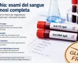Esami del sangue per la diagnosi celiachia: provette con Anti-tTG e Anti-EMA, foglio con analisi e simbolo Gluten Free.