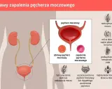 Ból i pieczenie przy oddawaniu moczu to objawy zapalenia pęcherza. Ilustracja pokazuje układ moczowy i symptomy infekcji.