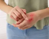 Mano con bruciatura da piastra, arrossata e con crema applicata.
