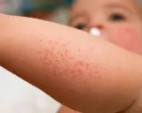 Bébé avec un bouton de chaleur sur le bras. Petits points rouges sur la peau.