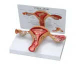 Model anatomiczny narządu rodnego kobiety z widoczną torbielą na jajniku.