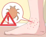 Un pied présente des piqûres rouges, signe d'un orteil qui gratte le soir à cause d'un acarien.