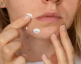 Co na pryszcze na twarzy? Sprawdzone metody i rady dermatologa.