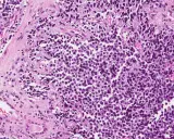 Microscopia di rabdomiosarcoma alveolare: cellule tumorali con nuclei scuri e citoplasma scarso, disposte in nidi separati da tessuto connettivo.