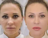 Kwas hialuronowy: Sekret nawilżenia i młodej skóry? Sprawdź!