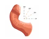 Ilustracja przedstawia prącie z zaznaczonymi kątami (0°, 30°, 60°, 90°), co może być związane z oceną uszkodzenia prącia objawy.