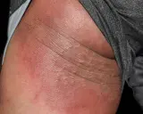 Arrossamento e piccole vescicole sulla pelle, indicative di dermatite sedere adulto.
