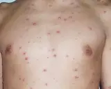 Torso y brazo de persona con granitos varicela leve, pequeños y rojizos, indicando una erupción cutánea.
