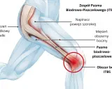 Anatomia bólu kolana: rolowanie pasma biodrowo piszczelowego pomaga rozluźnić napinacz powięzi szerokiej i mięsień pośladkowy wielki.