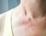 Czerwona, swędząca wysypka na szyi i klatce piersiowej, typowe objawy alergii pokarmowej na skórze.