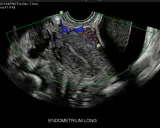 Ecografia pelvica con evidenza di vascolarizzazione anomala, possibile indicatore di tumore ovario.