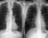 Zwei Röntgenaufnahmen des Brustkorbs zeigen Anzeichen von COPD. Ein rosa Puffer könnte zur Linderung der Symptome beitragen.